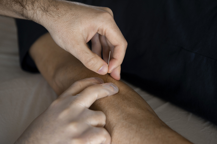 Physiotherapist doing a dry puncture